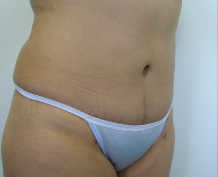 After Image: Patient # 87805 - 