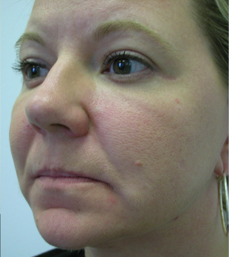 After Image: Patient # 50164 - 