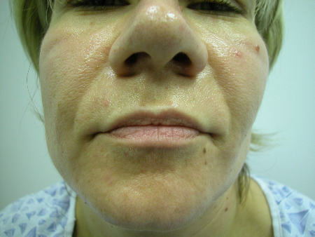 Before Image: Patient # 97248 - 