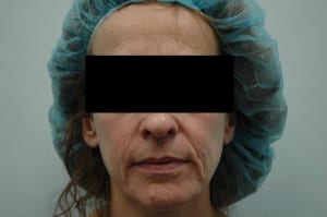 Before Facial Liposuction headshot showing woman in scrubs and black bar hiding eyes
