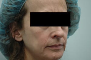 Before Facial Liposuction headshot showing woman in scrubs and black bar hiding eyes