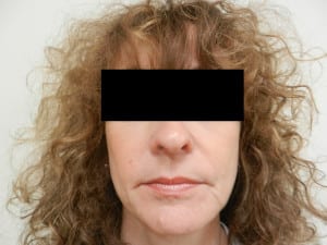 After Facial Liposuction headshot showing woman with black bar hiding eyes