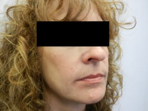 Before Facial Liposuction headshot showing woman with black bar hiding eyes