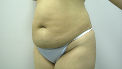 Before Image: Patient # 27742 - 