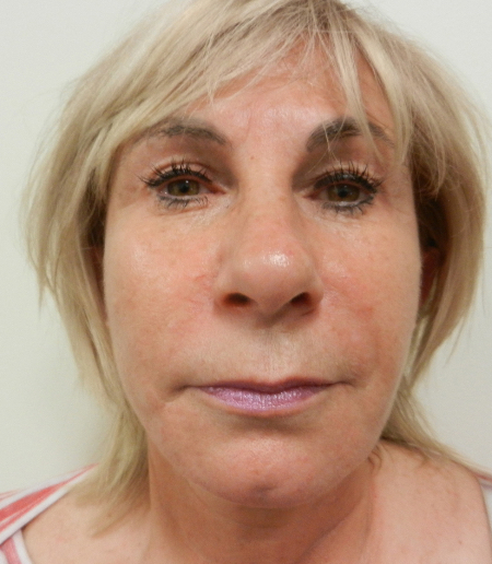 After Image: Patient # 26603 - 