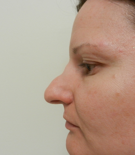Before Image: Patient # 36416 - 