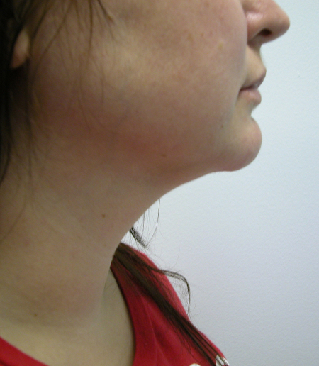 After Image: Patient # 32789 - 