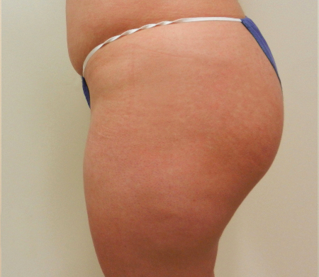 After Image: Patient # 27121 - 