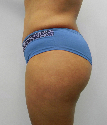 After Image: Patient # 45728 - 