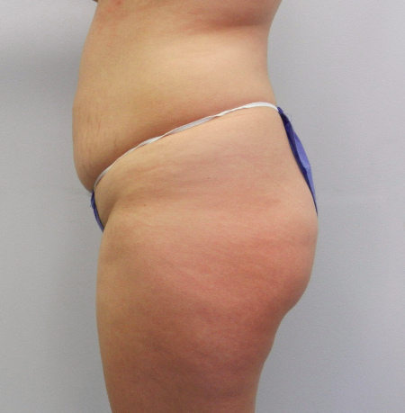 Before Image: Patient # 24700 - 