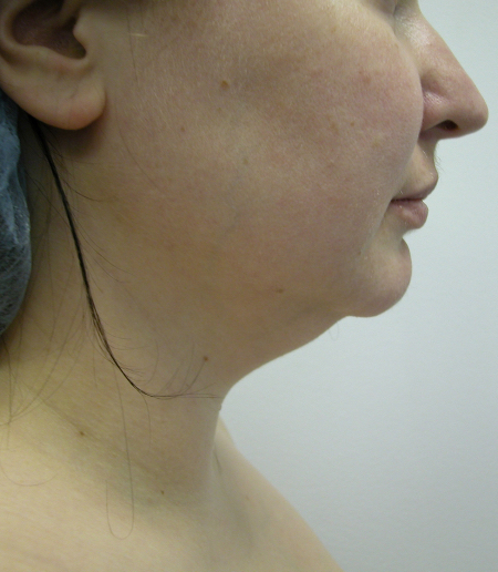 Before Image: Patient # 32789 - 