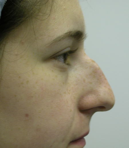 Before Image: Patient # 81117 - 