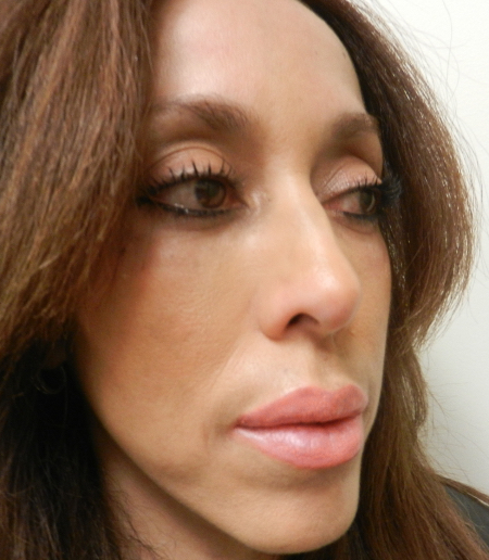 After Image: Patient # 92852 - 