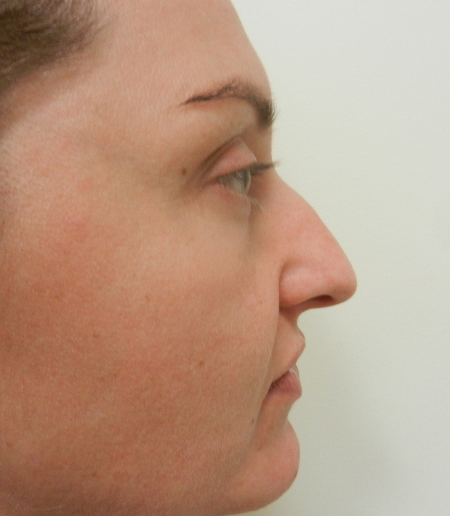 Before Image: Patient # 32662 - 