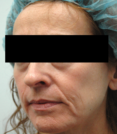 Before Image: Patient # 41753 - 
