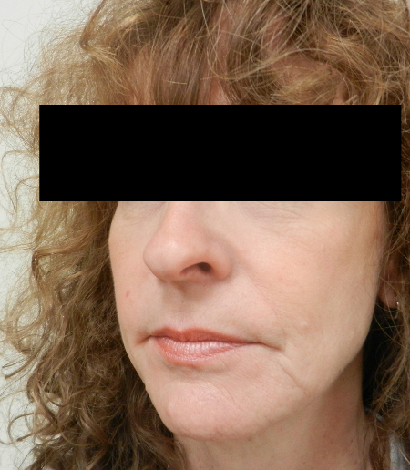 After Image: Patient # 41753 - 