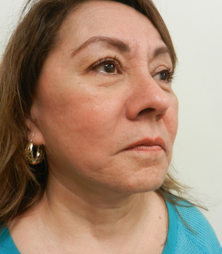 After Image: Patient # 29556 - 