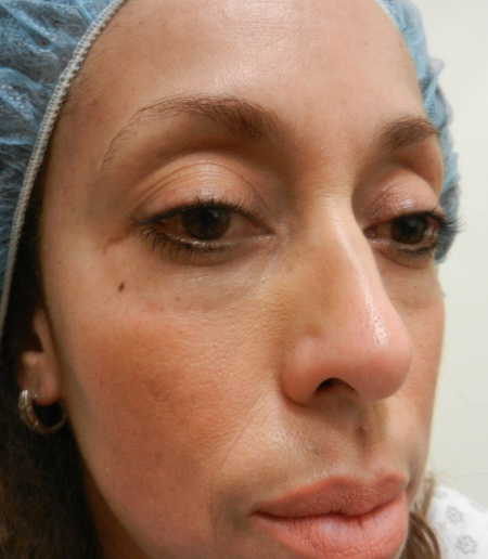 Before Image: Patient # 92852 - 