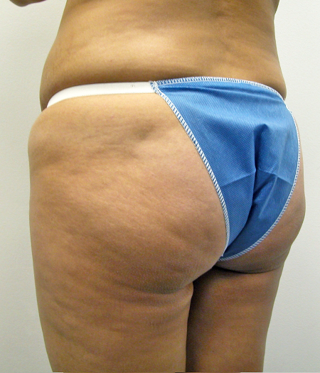 Before Image: Patient # 47047 - 