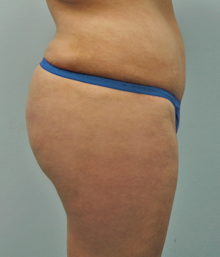 After Image: Patient # 65165 - 