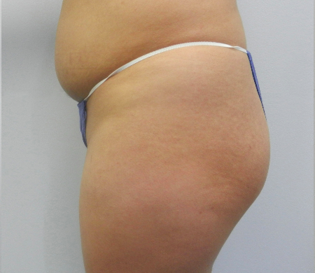 Before Image: Patient # 27121 - 