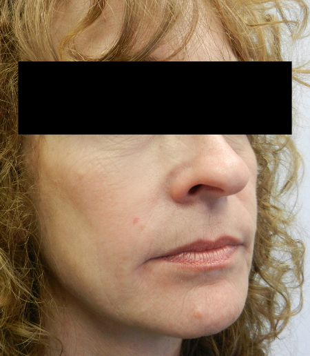 After Image: Patient # 41753 - 