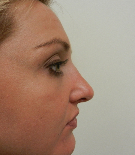 After Image: Patient # 32662 - 