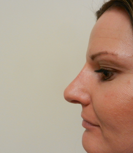 After Image: Patient # 36416 - 