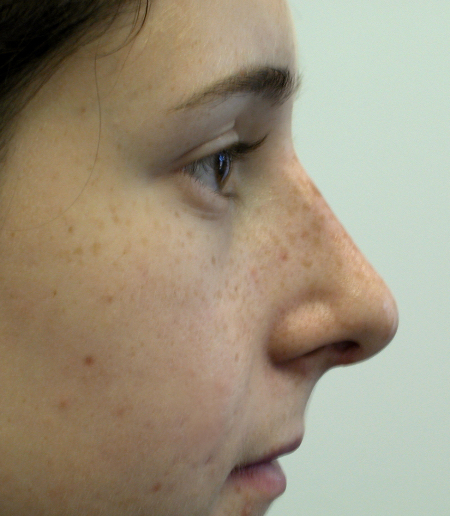 After Image: Patient # 81117 - 