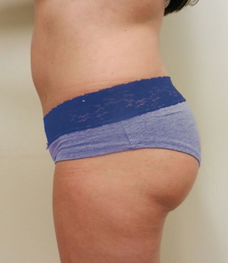 After Image: Patient # 59349 - 