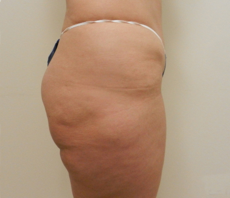 Before Image: Patient # 15869 - 