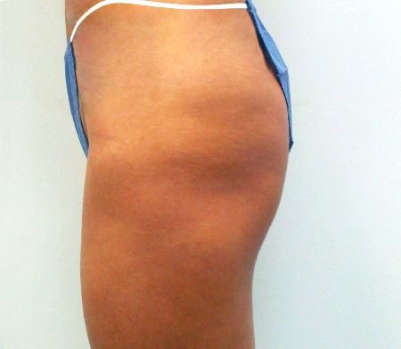 Before Image: Patient # 34476 - 