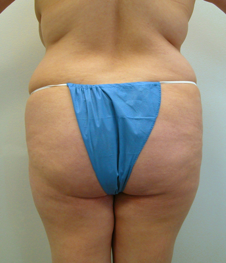 Before Image: Patient # 65165 - 