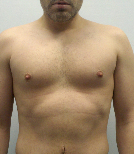 After Image: Patient # 74223 - 