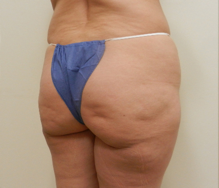 Before Image: Patient # 15869 - 