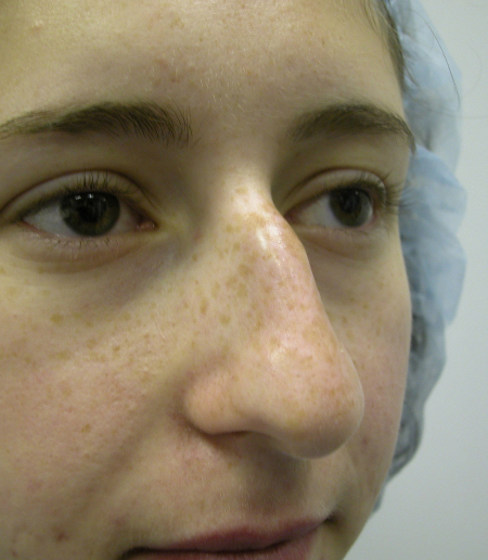 Before Image: Patient # 81117 - 