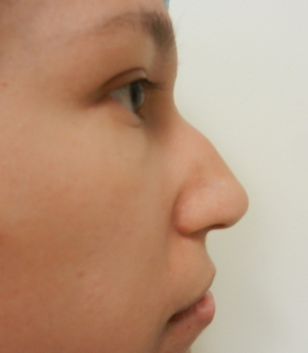 Before Image: Patient # 71624 - 