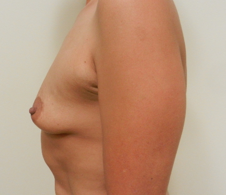 Before Image: Patient # 86377 - 