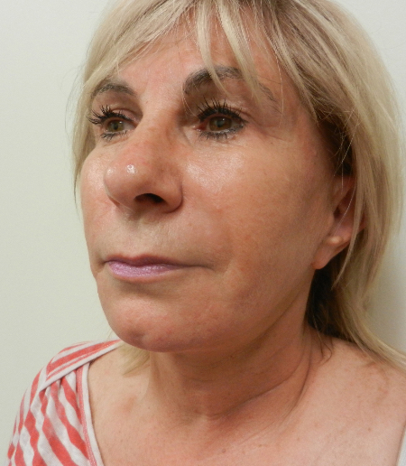 After Image: Patient # 26603 - 