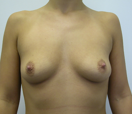Before Image: Patient # 34636 - 