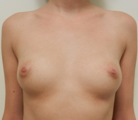Before Image: Patient # 36793 - 