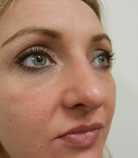After Image: Patient # 32662 - 