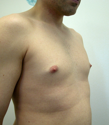 Before Image: Patient # 74223 - 