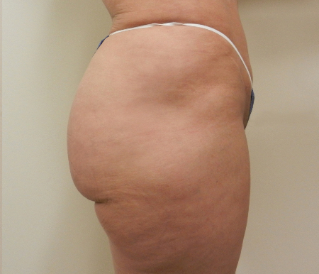 After Image: Patient # 15869 - 