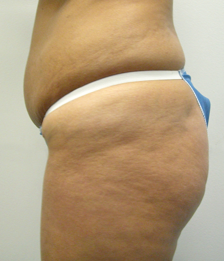 Before Image: Patient # 47047 - 