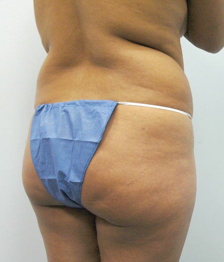 Before Image: Patient # 45728 - 