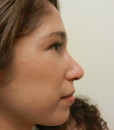 After Image: Patient # 71624 - 