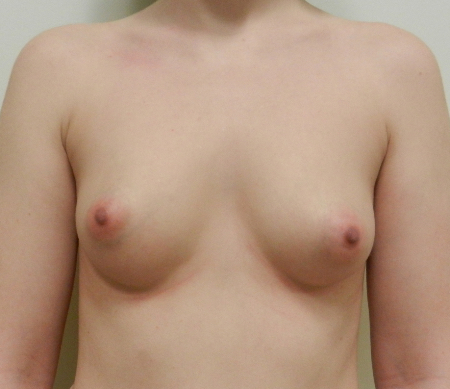 Before Image: Patient # 33256 - 