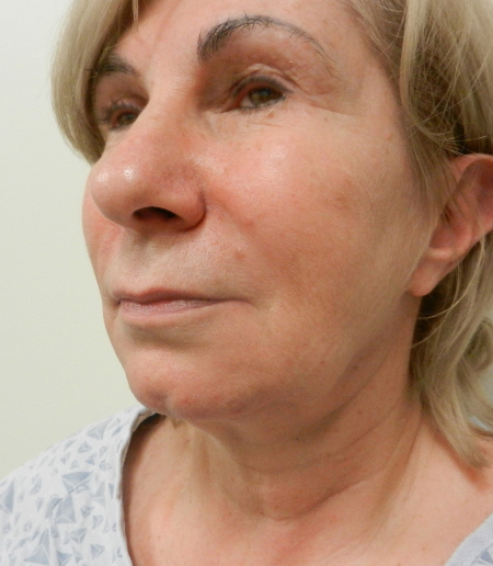 Before Image: Patient # 26603 - 