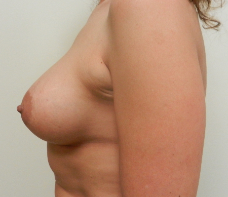 After Image: Patient # 86377 - 